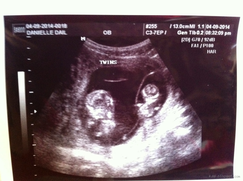 At What Point Can You See Twins on an Ultrasound?