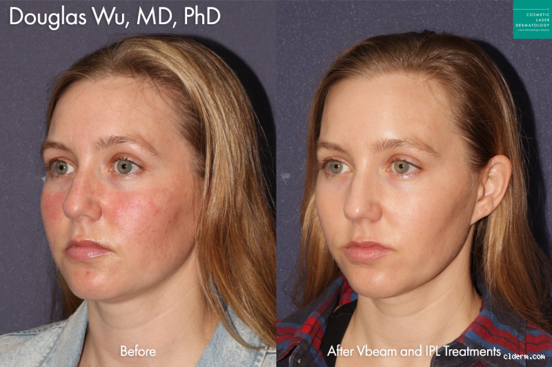 Can I Use IPL Every 3 Days? What You Must Know Before Trying
