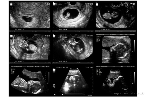 Can Ultrasound Be Wrong in Early Pregnancy? What You Need to Know