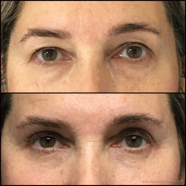 Does Fat Come Back After Blepharoplasty? – Stories, Stats, and Surprises