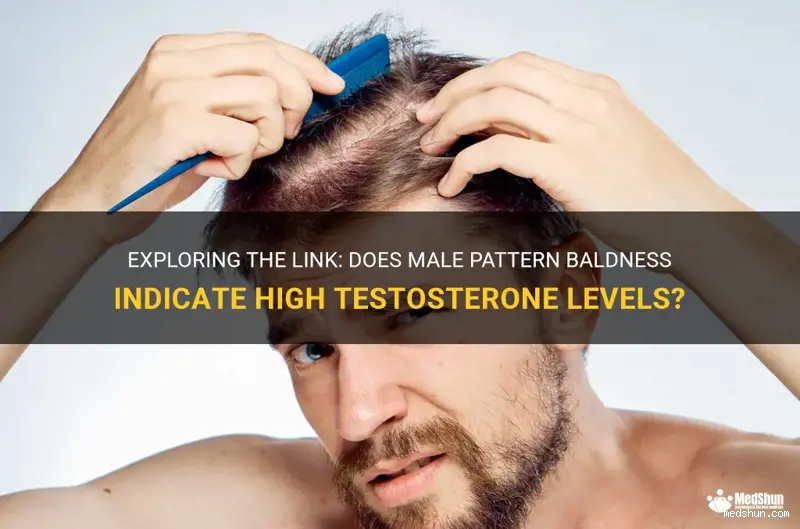 Does Male Pattern Baldness Mean High Testosterone? Here's What You Need to Know