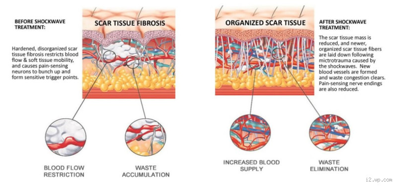 Does Scar Tissue Really Get Worse With Age?