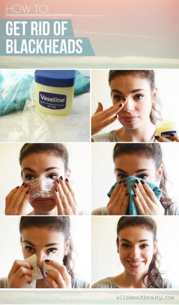 How to Get Rid of Blackheads Overnight at Home: Quick & Easy Tips