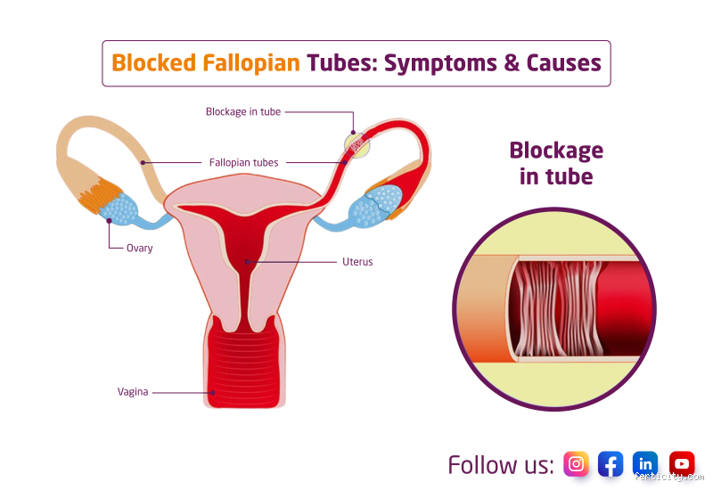 How Do You Know If Your Fallopian Tubes Are Blocked? Key Signs You Shouldn't Ignore