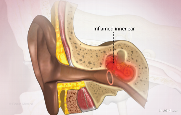 How Long Does a Bacterial Inner Ear Infection Last?