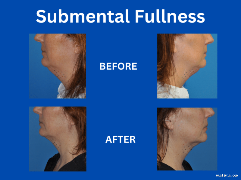 How to Remove Chin Fat Naturally? Simple Tips That Actually Work