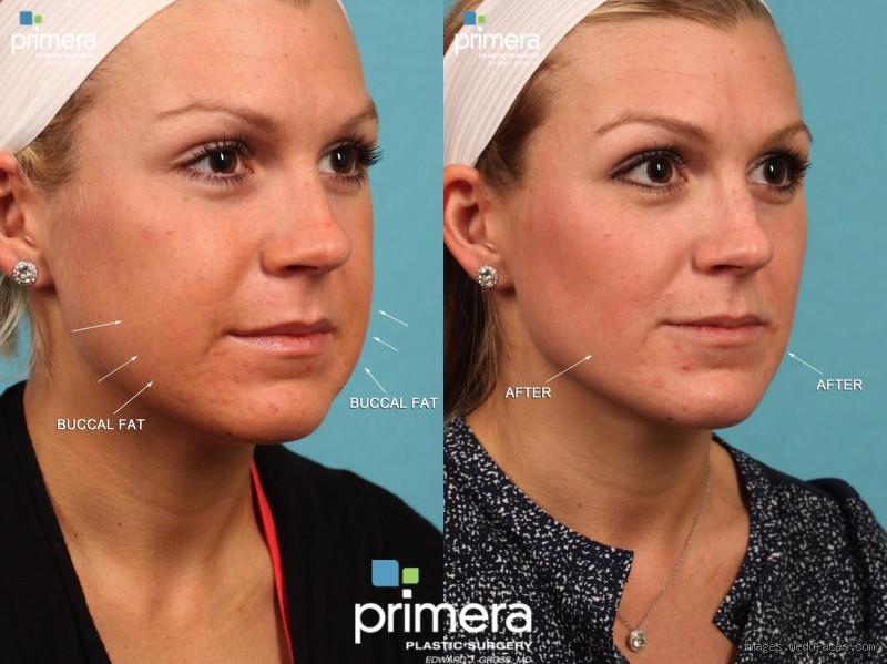 Is Face Fat the First to Go? The Surprising Truth Uncovered