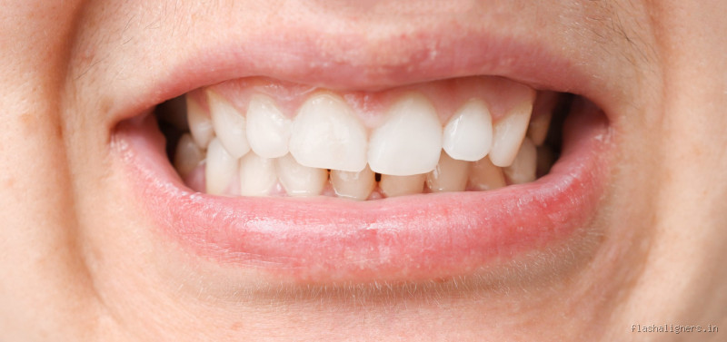 What Does a Misaligned Jaw Look Like? Signs You Shouldn’t Ignore