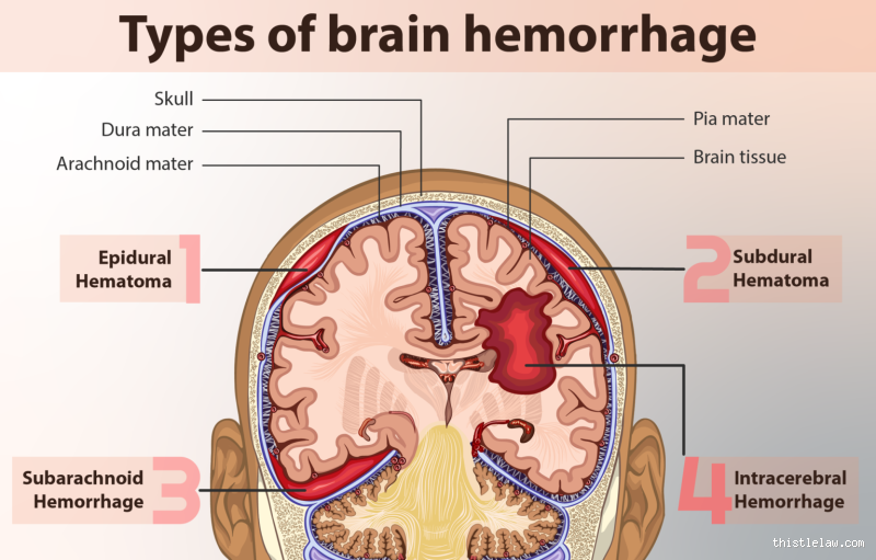 What Does a Small Bleed on the Brain Mean? Understanding the Risks