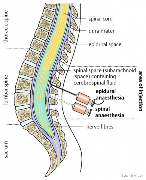 What Hurts More: Spinal or Epidural? A Closer Look