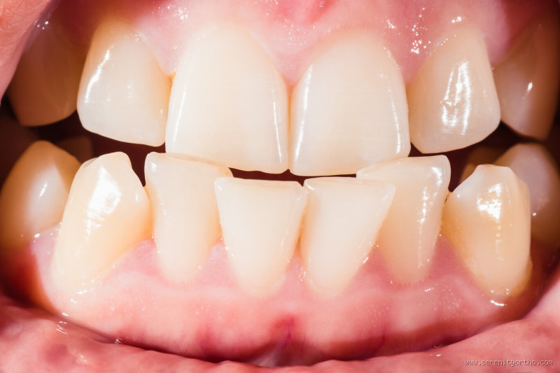 Why Do Teeth Shift Easily? Discover Surprising Causes and Prevention Tips!