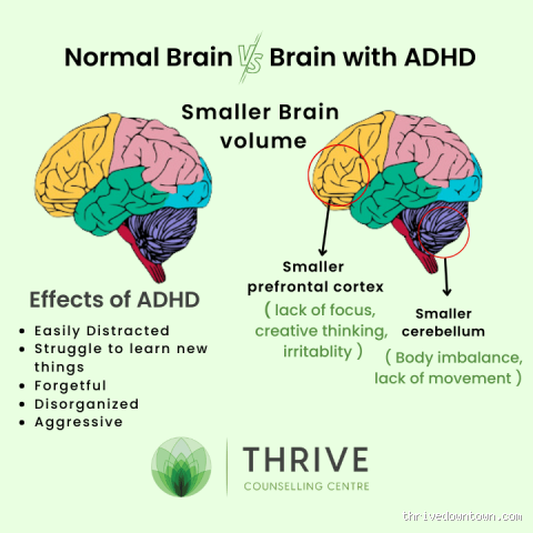 Why Does the ADHD Brain Go So Fast? Unraveling the Mystery