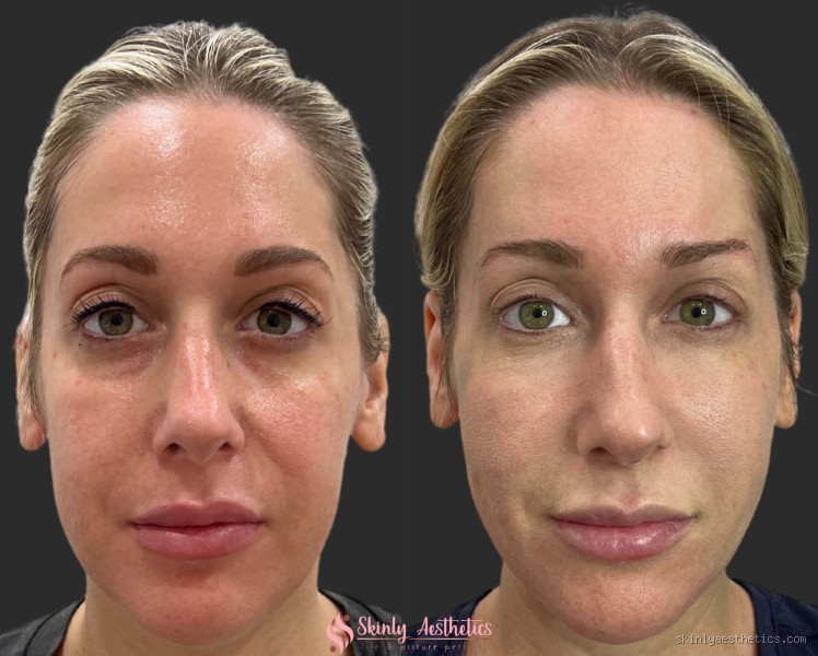 Are Cheek Fillers a Good Idea? The Truth You Need to Know