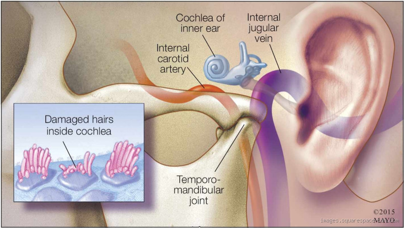 Do Ears Ring in Silence? Exploring the Mystery of Tinnitus
