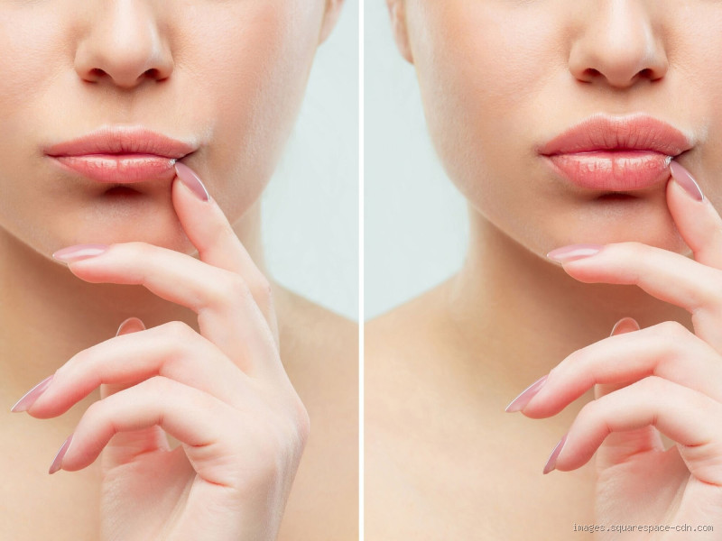 What Are Russian Lips? The Trend Everyone's Talking About